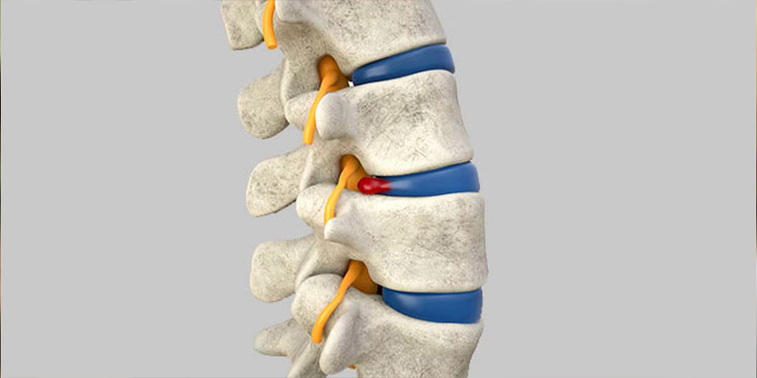 patient needing herniated disc in Austin